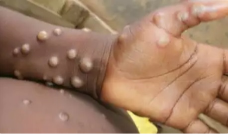 WHO Tetapkan Mpox sebagai Darurat Kesehatan Global, Indonesia Siaga